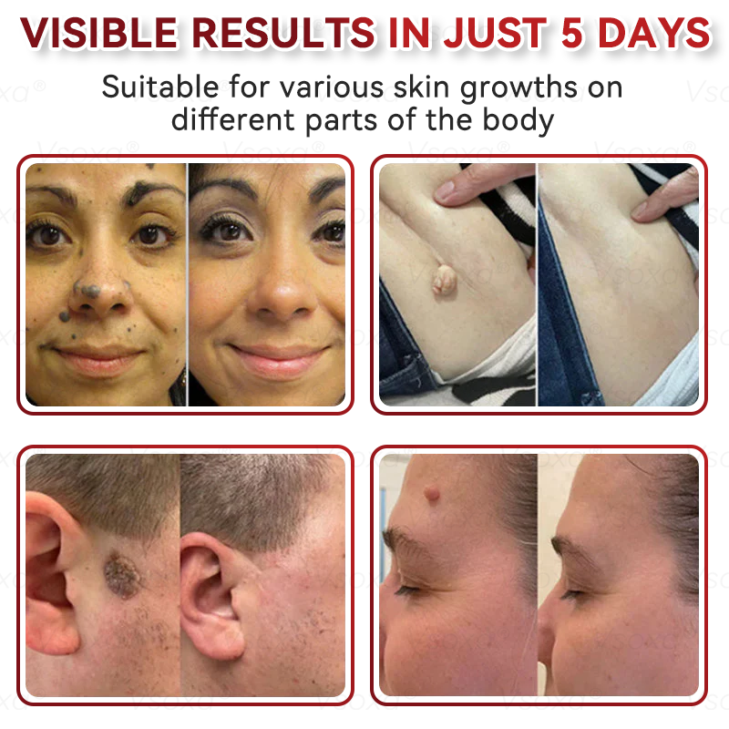 𝑉𝑠𝑜𝑥𝑎® 💧Microneedles Botanical Skin Tags Solution Patches - Made in the USA👩‍⚕️